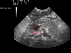 Анэхогенное что значит