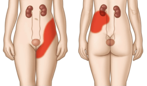 Болит левая почка и отдает в ногу
