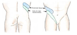 Болит левая почка и отдает в ногу