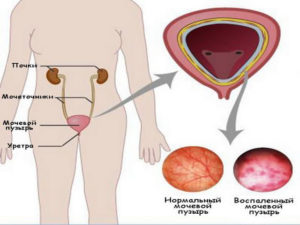 Болит низ живота где мочевой пузырь