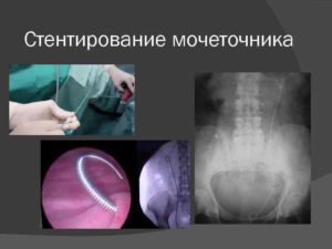 Болит почка после установки стента