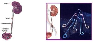 Болит почка после установки стента