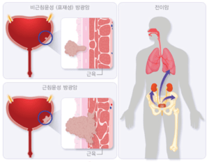 Больно писать женщине и кровь в моче