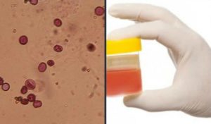 Больно писать женщине и кровь в моче