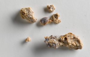 Чем растворить камни в почках народными средствами