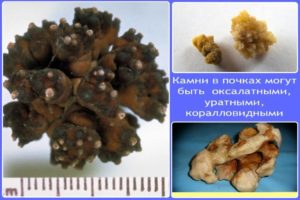 Чем растворить камни в почках народными средствами