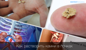 Чем растворить камни в почках народными средствами