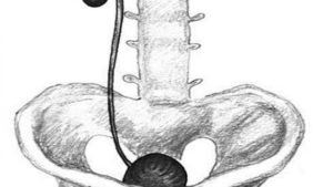 Что будет если у человека 1 почка