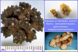 Что делать когда выходят камни из почек