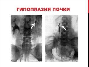 Что такое гипоплазия почки у взрослого человека