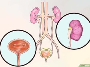 Цистит восходящий пиелонефрит