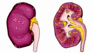 Цистит восходящий пиелонефрит