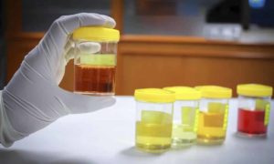 Цвет мочи при цистите у женщин