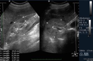 Диффузно неоднородные изменения структуры синусов обеих почек