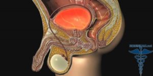 Эндометриоз и уретрит