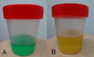 Фуразолидон окрашивает мочу в желтый цвет
