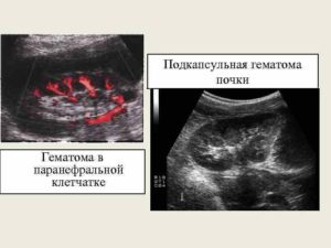 Гематома в почке лечение