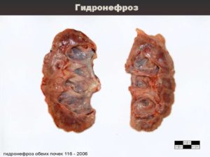 Гидронефроз 3 степени правой почки у ребенка