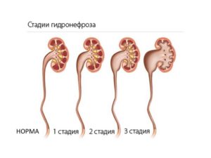 Гидронефроз почек у беременных