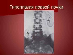 Гипоплазия почки причины