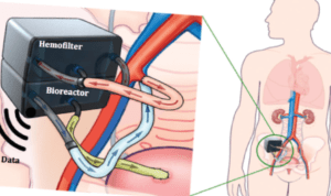 Имплантируемая искусственная почка 2016