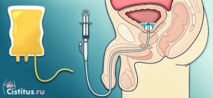 Инсталляция мочевого пузыря что это такое