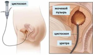 Инсталляция мочевого пузыря что это такое