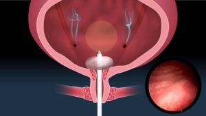 Инсталляция мочевого пузыря что это такое