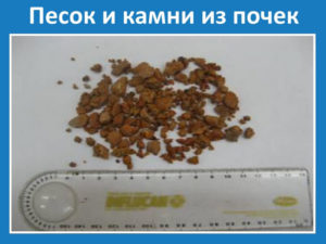 Как понять что идет песок из почек