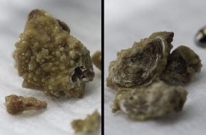 Камни в почках из за курения