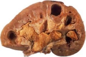 Камни в почках из за курения