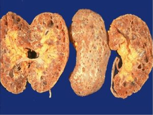 Камни в почках из за курения