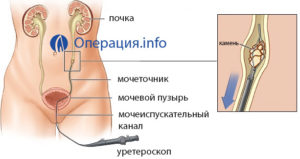 Катетер в почке при камнях
