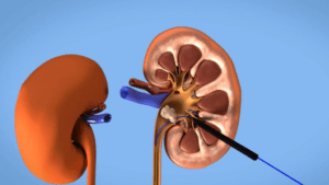Катетер в почке при камнях