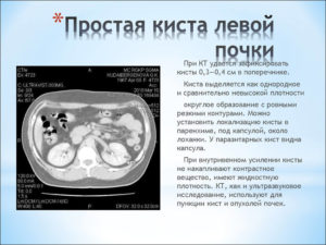 Киста на левой почке какое лечение