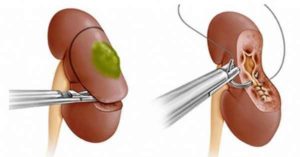Киста на почке у ребенка 6 лет