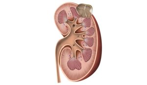 Киста обеих почек что делать