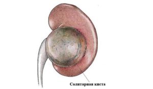 Киста обеих почек что делать