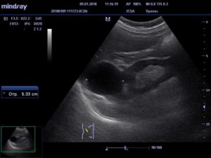 Киста в почке в паренхиме