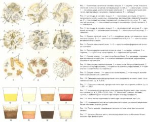 Кристаллы в моче повышены у ребенка