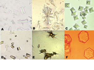 Кристаллы в моче повышены у ребенка