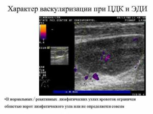 Кровоток при цдк не определяется