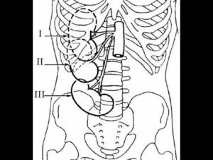 Лечение опущение почки 3 степени