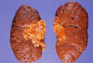 Лечение сморщивание почек