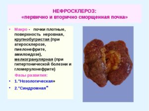 Лечение сморщивание почек