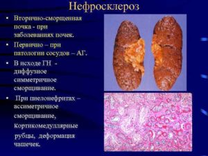 Лечение сморщивание почек