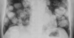 Метастазы 4 степени