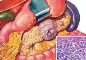 Метастазы 4 степени