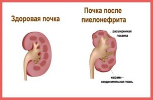 Может быть температура при заболевании почек