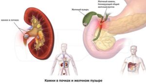 Можно ли пить алкоголь когда камни в почках
